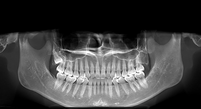 2026.3.17看完牙科了，17年拔两颗，18年拔两颗，上个月去洗牙发现又长了一颗焦虑死我，医生说不用拔，牙齿不会再长，等2029再拍个片确认下，说我牙挺好的😅开熏，今晚可以好好睡觉了2026.3.17看完牙科了，17年拔两颗，18年拔两颗，上个月去洗牙发现又长了一颗焦虑死我，医生说不用拔，牙齿不会再长，等2029再拍个片确认下，说我牙挺好的😅开熏，今晚可以好好睡觉了